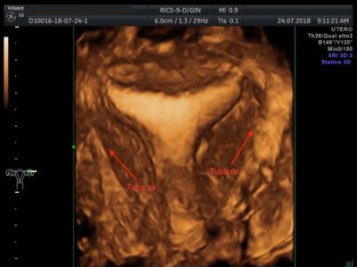 eco vaginale 3D